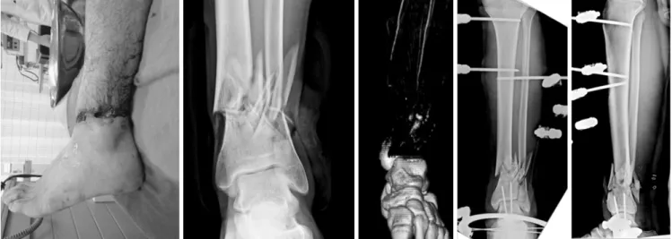 Fig. 4. Open type IIIc distal tibia and fibular fracture of a 31-year-old male was treated with vascular reconstruction and temporary external fixation.