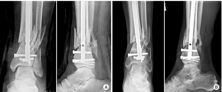 Fig. 6. (A) Under the diagnosis of infected nonunion, radical debridement of the infected tissue was performed and the fracture was stabilized  by an external fixator