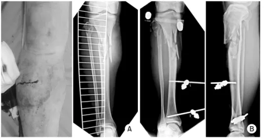 Fig. 7. (A) Clinical photography and X-ray  show open comminuted proximal tibia  fracture of a 72-year-old male