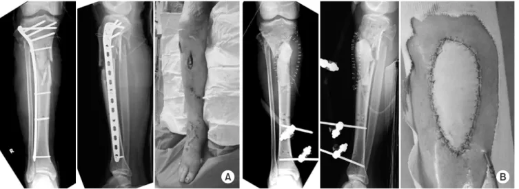 Fig. 8. (A) An X-rays and clinical photography taken 5 months after the injury showed infected nonunion after definite plate fixation with soft tis- tis-sue defect
