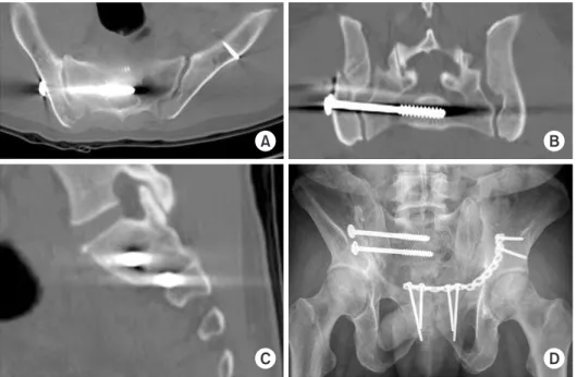 Fig. 2. Malposition of the S2 screw in the  S1 foramen was identified in the axial  (A), coronal (B), and sagittal (C) images  of postoperative computed tomography