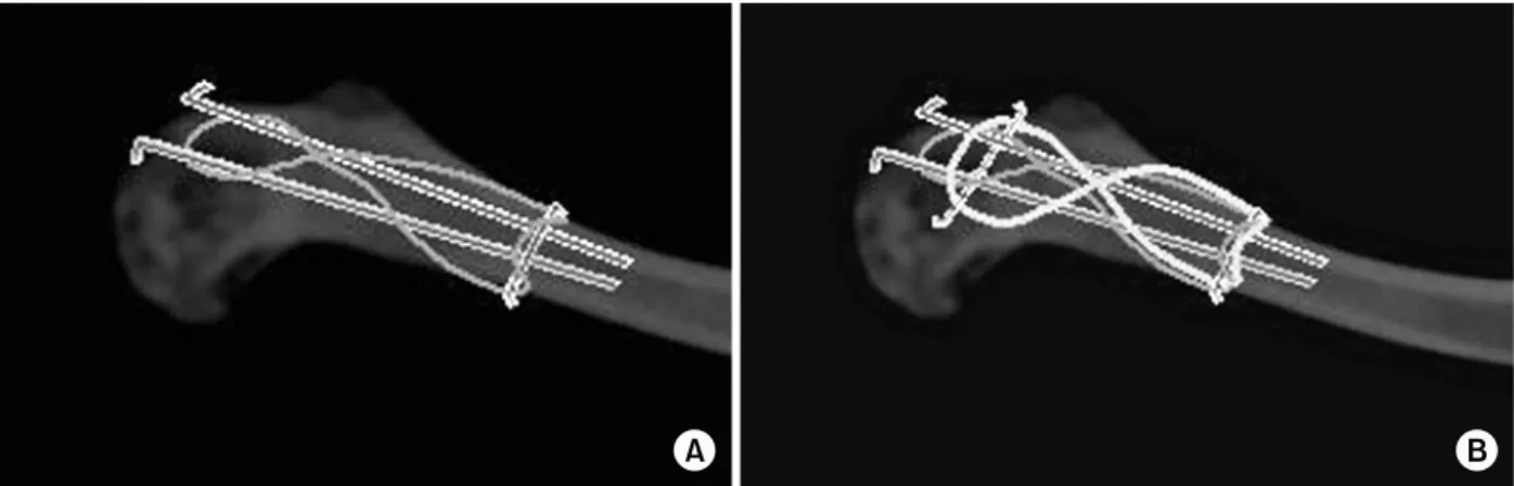 Fig. 2. A demonstration model of the double tension band  wire fixation.