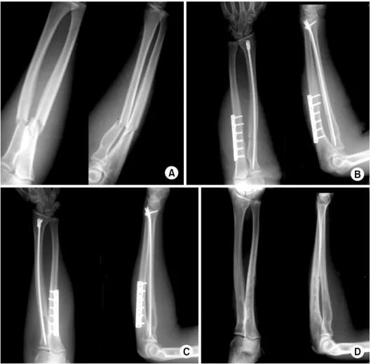 Fig. 2. (A) Preoperative radio- radio-graphs of the forearm of  17-year-old male patient  showed ulnar oblique and  radial transverse shaft fracture after slip-down from the stairs