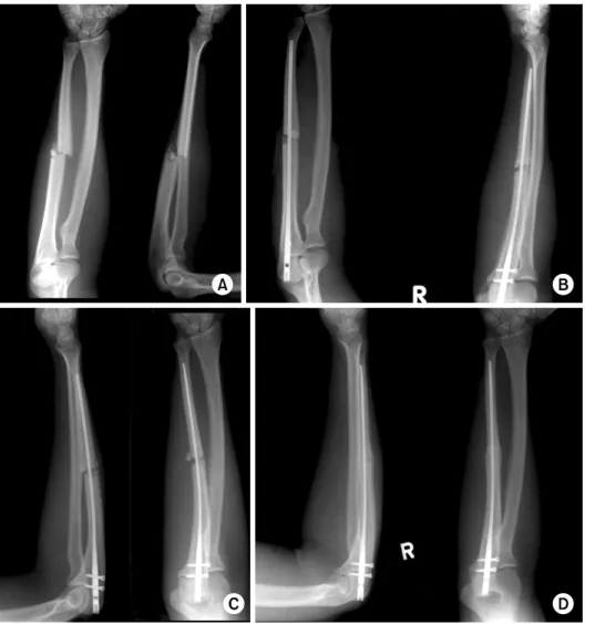 Fig. 3.  (A) Preoperative X-ray showed ulnar shaft  commi-nuted fracture. 