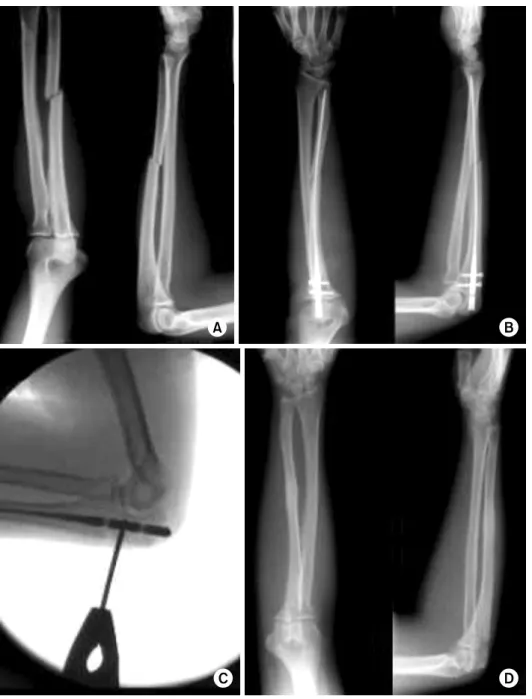 Fig. 4.  (A) Preoperative radio- radio-graphs of the forearm of  28-year-old female patient  showed ulnar transverse shaft fracture