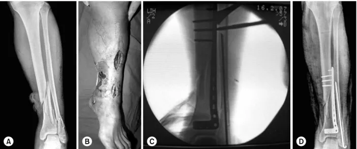 Fig. 1. (A) The initial film shows a comminuted fracture of the distal tibia with medial open wound