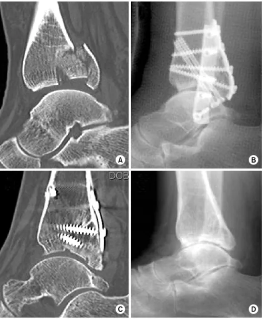 Fig. 4. (A) Preoperative sag- sag-ittal CT image showing  pos-terior malleolar fracture with  comminution