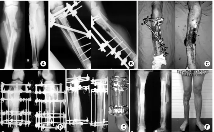 Fig. 2. The 27 year-old male sustained comminuted open fracture of the right tibia and fibula (Gustilo III-c type) with soft  tissue defect by traffic accident