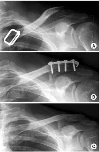 Fig. 2. (A) Distal clavicle comminuted fracture in a 47-year-  old man. 