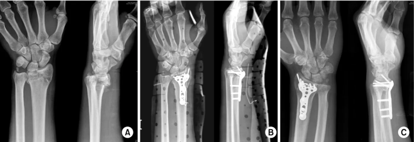 Fig. 2. 67-year-old woman with unstable distal radius fracture was treated by OR &amp; IF with Acu-loc Ⓡ  volar fixed angle plate  (BMD:  −3.5).