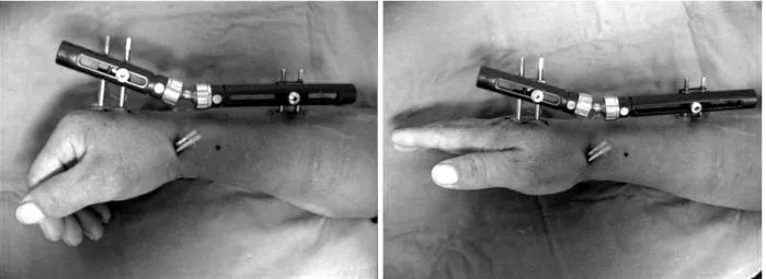 Fig. 5. Postop active ROM exercise after CR pinning &amp; EF with Penning Orthofix Ⓡ  external fixation (BMD: −2.7).