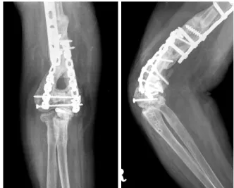 Fig. 5. Anteroposterior &amp; translateral radiographs of the right  elbow 10 months after the operation.