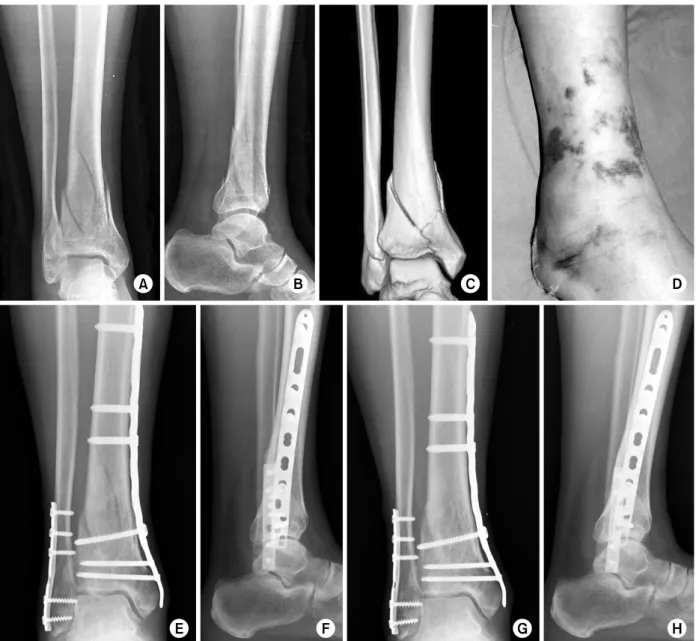 Fig. 1. (A∼C) Preoperative radiographs and 3-dimensional computed tomography of a 39 year-old man shows a distal tibia  and fibular fractures classified as the AO/OTA type C2