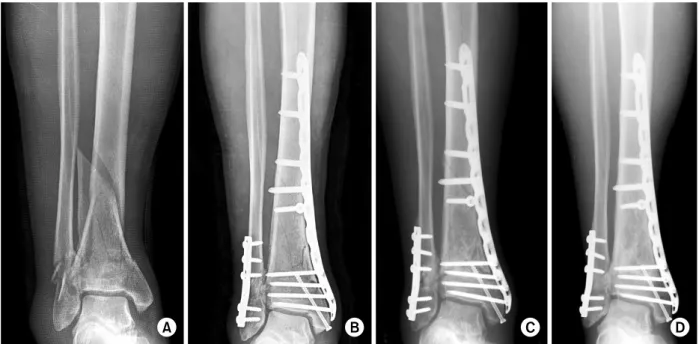 Fig. 2. (A) A 50 year-old man sustained distal tibia and fibular fractures classified as the AO/OTA type C2