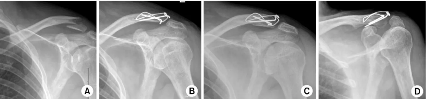 Fig. 1.   (A) Radiograph of 56-year-old male shows Neer type II distal clavicle fracture.