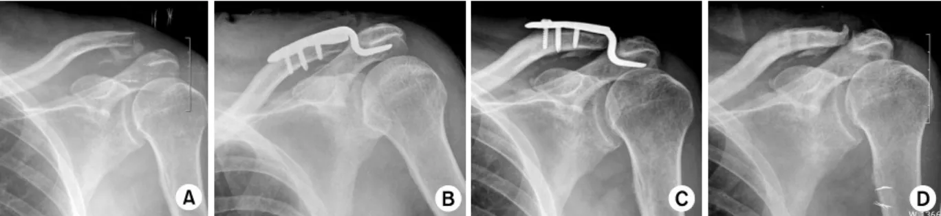 Fig. 2. (A) Radiograph of 57-year-old male shows Neer type II distal clavicle fracture.