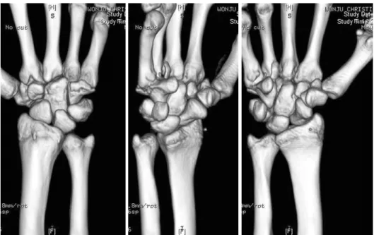 Fig. 1. Three-dimensional re- re-construction image of  com-puted tomography shows the  intraarticular fractures occurred simultaneously in the fourth  and fifth metacarpal base.
