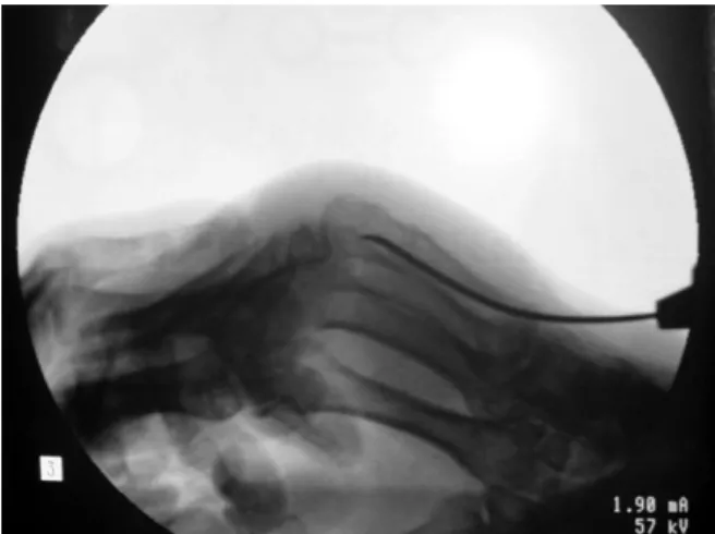 Fig. 2. The wire is inserted through the ulnar cortex of the  little finger metacarpal base, after 5 mm incision.