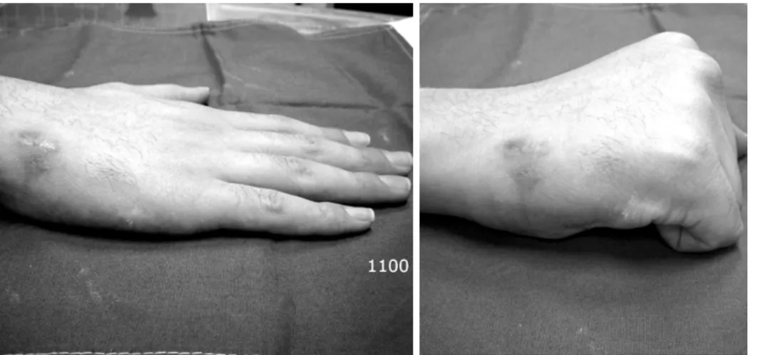 Fig. 8. Phoptograhs show full  range of motion.     임상적  평가에서  1명에서  불만족  (보통)을  보였고  그  외에는  전원에서  만족  (우수  26명,  양호  4명)을  보였다.1