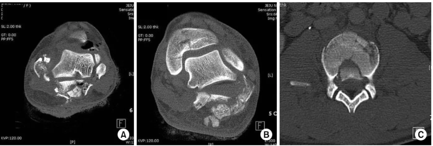 Fig. 2. (A) Right and (B)  left CT semi-coronal view shows the Sanders type IV with severe comminution