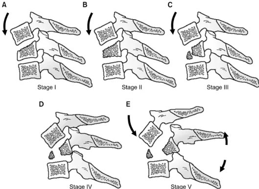 Fig. 1. Compressive flexion (CF) injuries are divided into five stages. The injury is speculated to occur first by flexion of the  spine through the facet joints