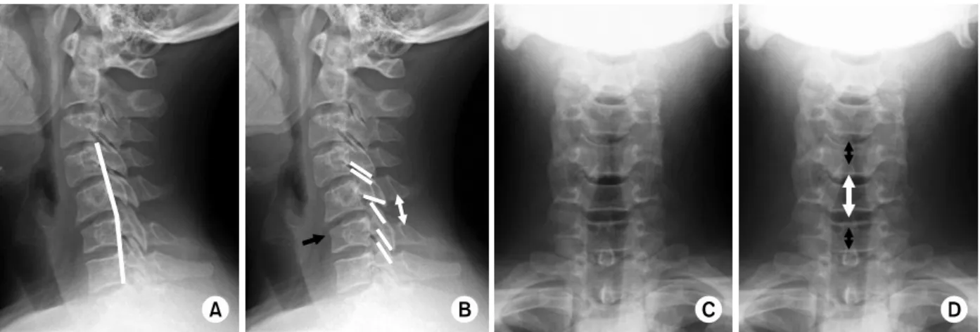Fig. 2. Anterior subluxation of C5 with wedge compression fracture of C6. 