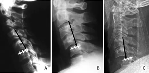 Fig. 6. Anterior vertebral translation in different flexion injuries. The amount of anterior translation with unilateral dislocation  (B) is less than occurs with bilateral facet dislocation (C) but greater than that of anterior subluxation (A)