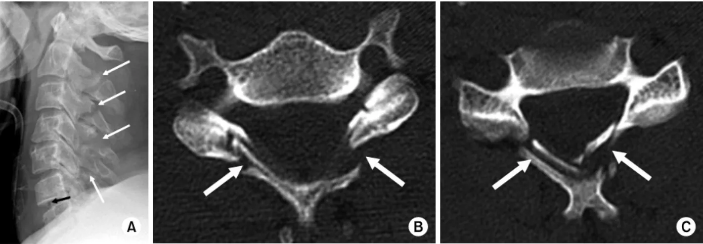 Fig. 9. Hyperextension comminuted laminar and spinous processes fractures. Cervical spine injuries caused by hyperextension  are characterized by distraction of the anterior and middle columns and compression of the posterior column (A)