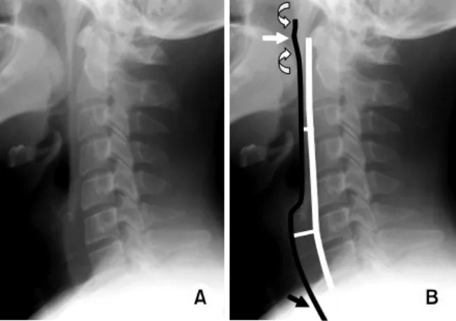 Fig. 12. Lateral radiograph (A) and sagittal CT multiplanar  reformation  (B)  of a normal cervical spine