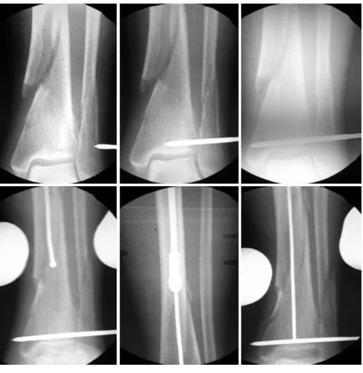 Fig. 2. The fluoroscopic X-rays (A∼D) reveal using the poller screw for accurate insertion nail