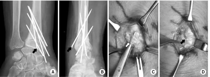 Fig. 1.  (A, B) Plain radiographs in 78 year-old female patient showed successful union with multiple K-wires fixation at 3  months after distal radius fracture surgery