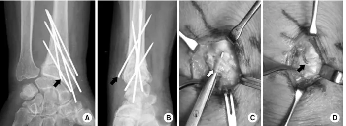 Fig. 1.  (A, B) Plain radiographs in 78 year-old female patient showed successful union with multiple K-wires fixation at 3  months after distal radius fracture surgery