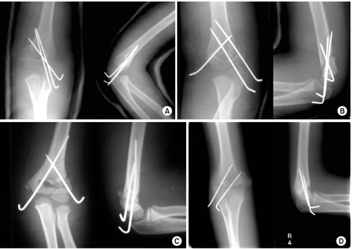 Fig. 1. Various techniques of pin fixation. 