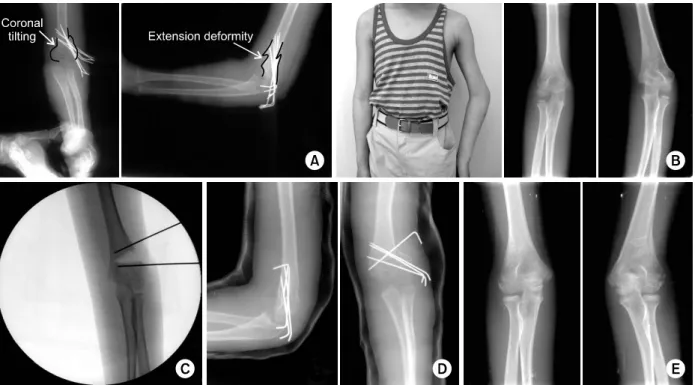 Fig. 12. Cubitus varus.