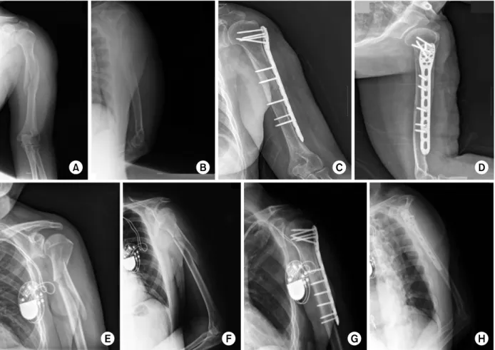 Fig. 1. (A, B) Preoperative radiographs of 63-year-old woman with comminuted meta-diaphyseal fracture of humerus