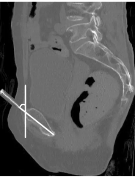 Fig. 3. With 3-dimensional reconstruction image, measuring  sagittal angle length at the medial insertion.