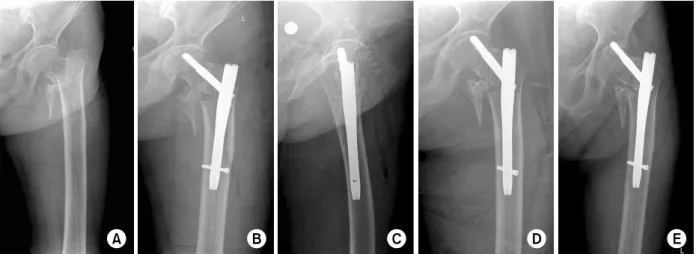 Fig. 2. (A) A 85-year-old female patient presented with intertrochanteric fracture as AO/ASIF classification A2.3