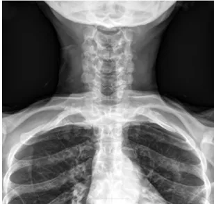 Fig. 3. Initial postoperative chest radiograph.