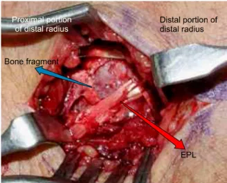 Fig. 5. (A, B) Open reduction and internal fixation with  Kirschner wires was done. 