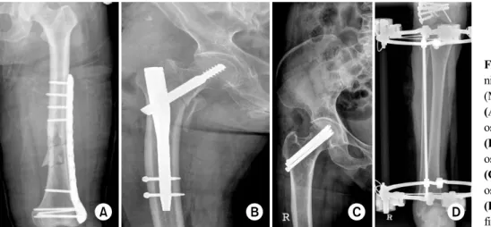 Fig. 1. Various kinds of mi- mi-nimally invasive osteosynthesis  (MIO).
