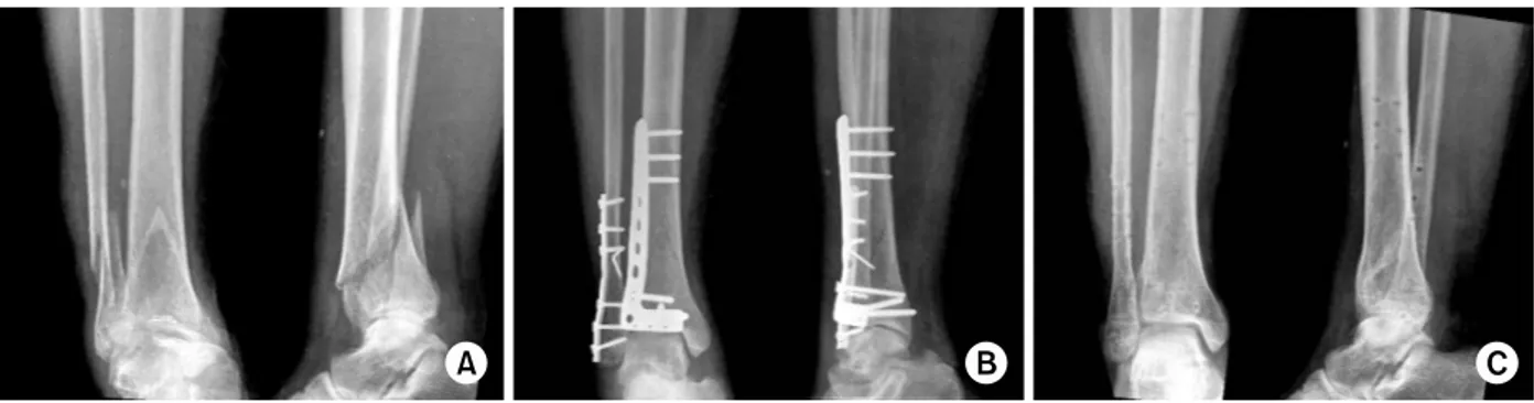 Fig. 2. Fracture of the distal lower leg in a 45-year-old man. 