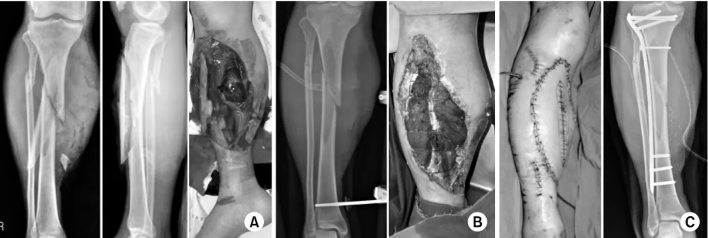 Fig. 3. Fracture of the lower leg in a 31-year-old man. 