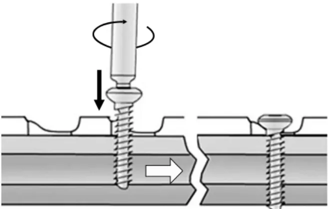 Fig. 1. Dynamic compression principle. Since the screw is  inserted into an inclined and transverse cylindrical holes in  DCP, the horizontal movement of the screw head can occur  along the screw hole