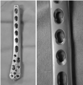 Fig. 3. Alternative holes of ZPLP (Zimmer Ⓡ , Warsaw, IN,  USA). 박  금속판으로  사용할  때는  일반적인  관혈적  정복술  및  내 고정의  원칙을  따라  사용될  수  있으나,  내고정기  금속판  혹은  두  가지  기능을  동시에  적용하는  금속판으로  사용할  때는  이에  맞는  수술  술기를  적절히  적용해야  바람직한  결 과를  얻을  수  있다