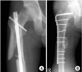 Fig. 10. (A) Malalignment and nonunion was shown eight  months after intramedullary (IM) nailing was performed for  segmental subtrochanteric femur fracture