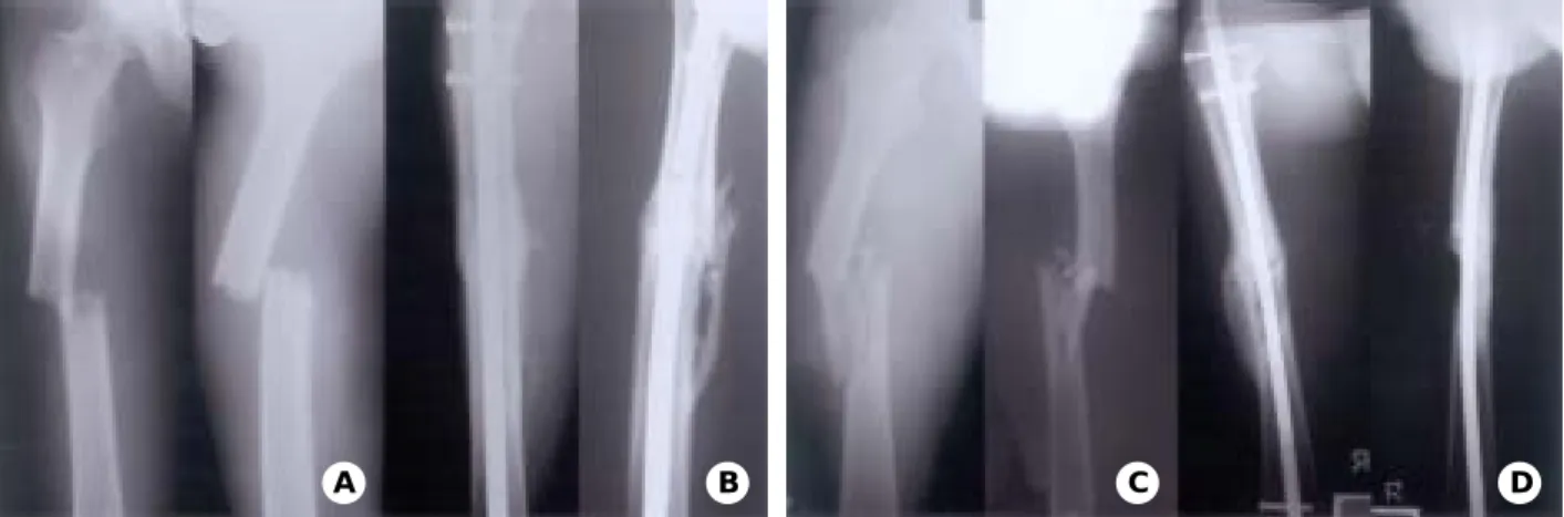 Fig. 4A-D. (A) Winquist-Hansen type 1 facture of  a 20 year-old man 