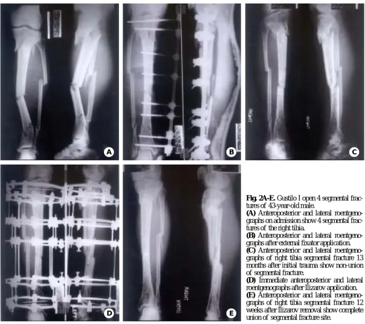 Fig. 2A-E. Gustilo I open 4 segmental frac-  tures of  43-year-old male. 