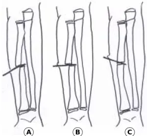 Table 1. Functional result by Thomas 