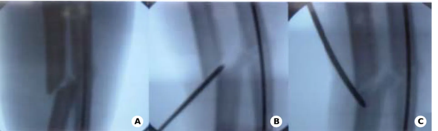 Fig. 2A-C. Photographs show sequence of  reduction under fluoroscopy. 