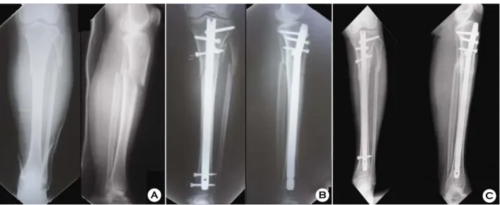 Table 2. Last follow up sagittal plane malalignment